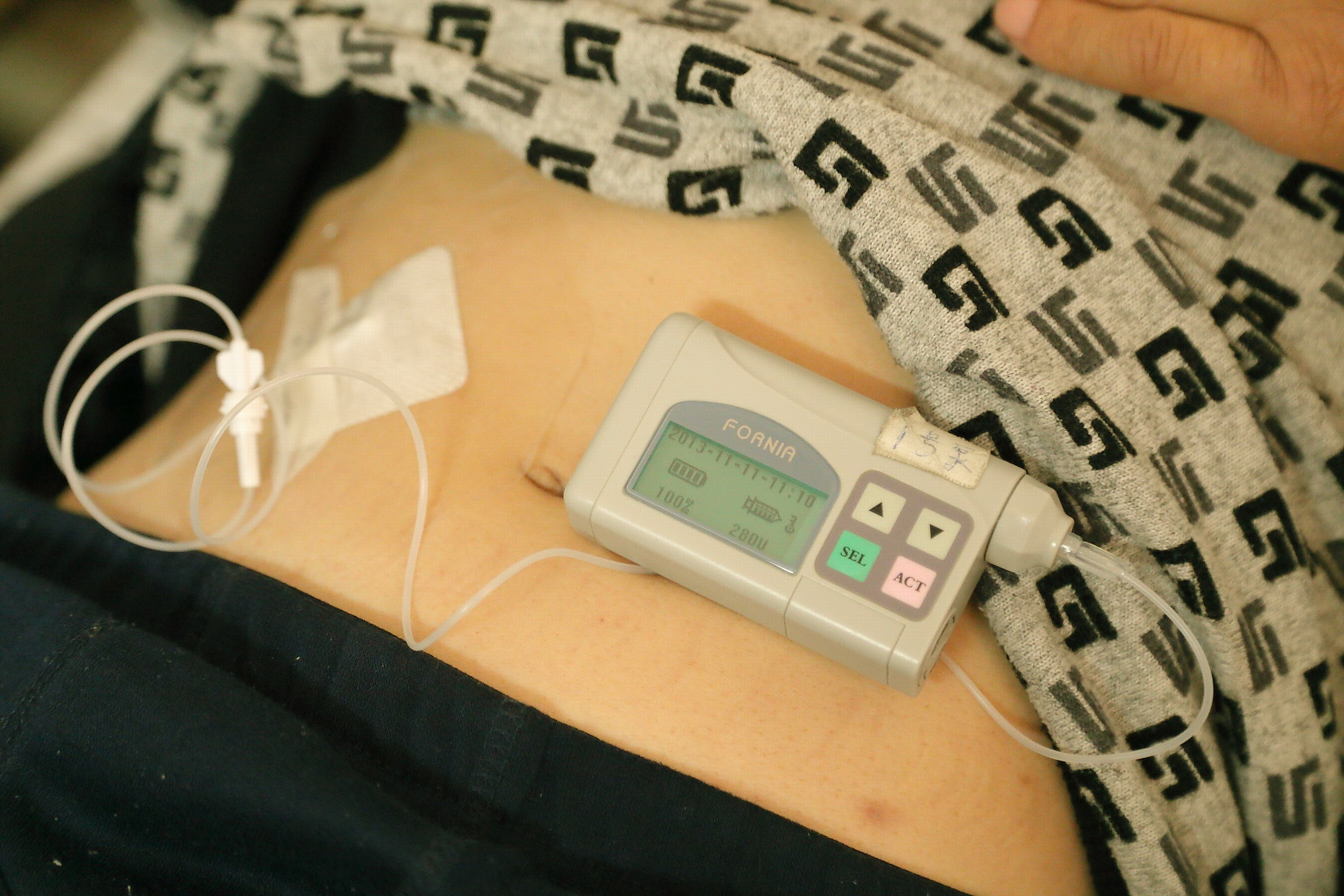 内分泌科特色诊疗技术—胰岛素泵简介