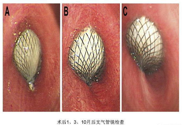 房间隔缺损封堵器成功治疗结核性支气管胸膜瘘