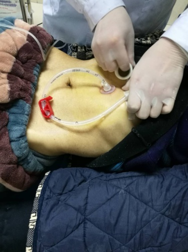 阜阳市二院成功开展经皮胃造瘘术