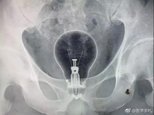 灯泡跑进肛门了万人讨论咋取出来