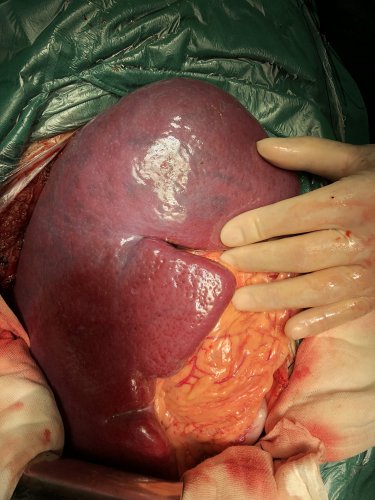 阜阳市二院肝胆外科成功切除临床罕见巨脾